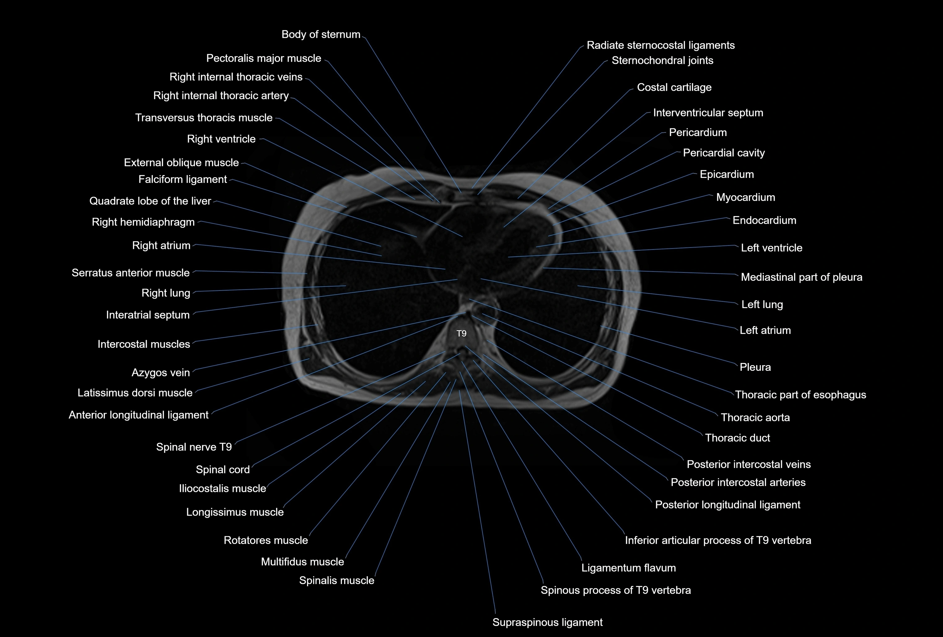 MRI Abdomen axial cross sectional anatomy radiology  image-img-00001-00001.webp